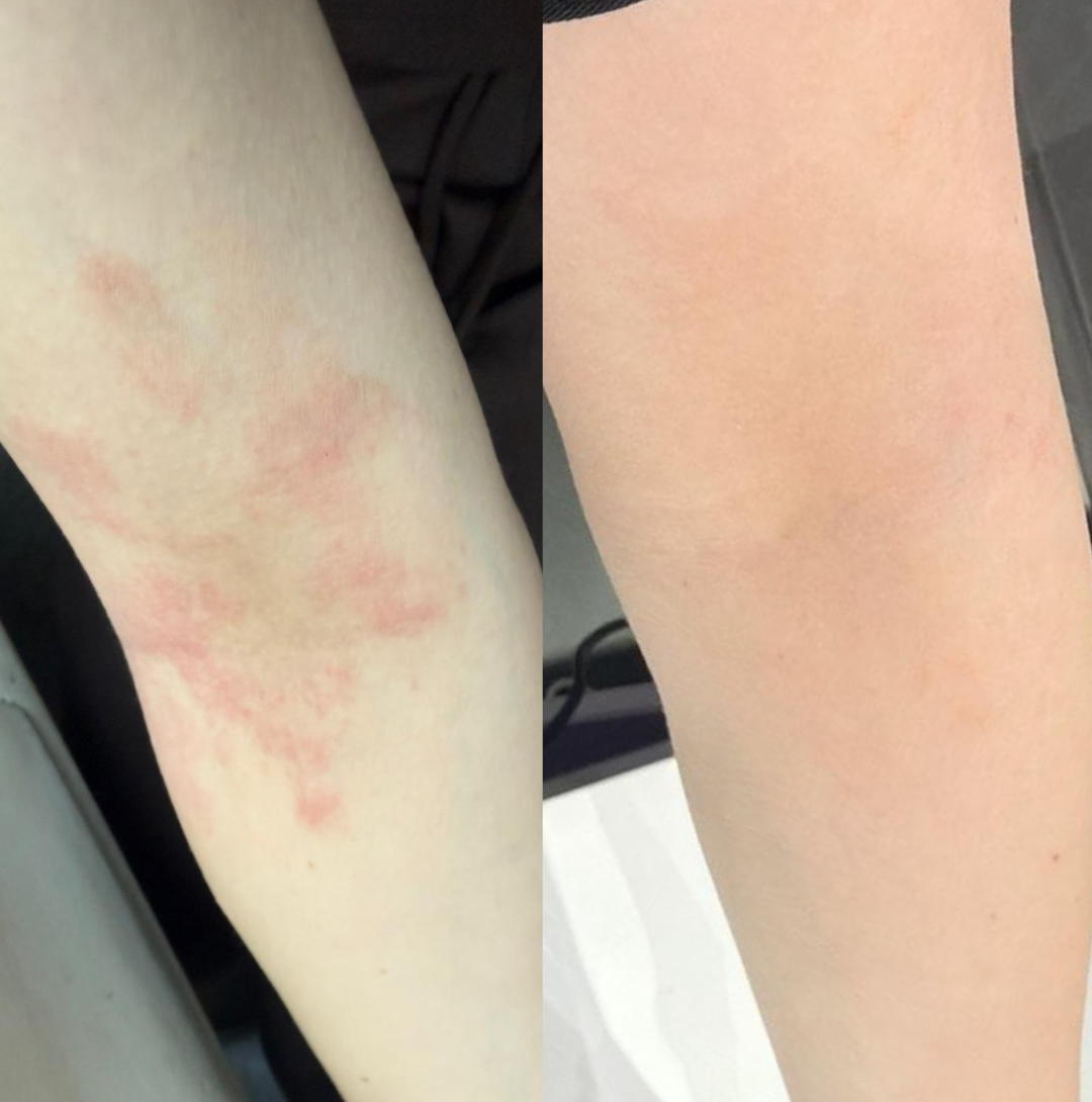 Before and after comparison of a person's arm with visible redness on the left and normal skin tone on the right.