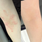 Before and after comparison of a person's arm with visible redness on the left and normal skin tone on the right.